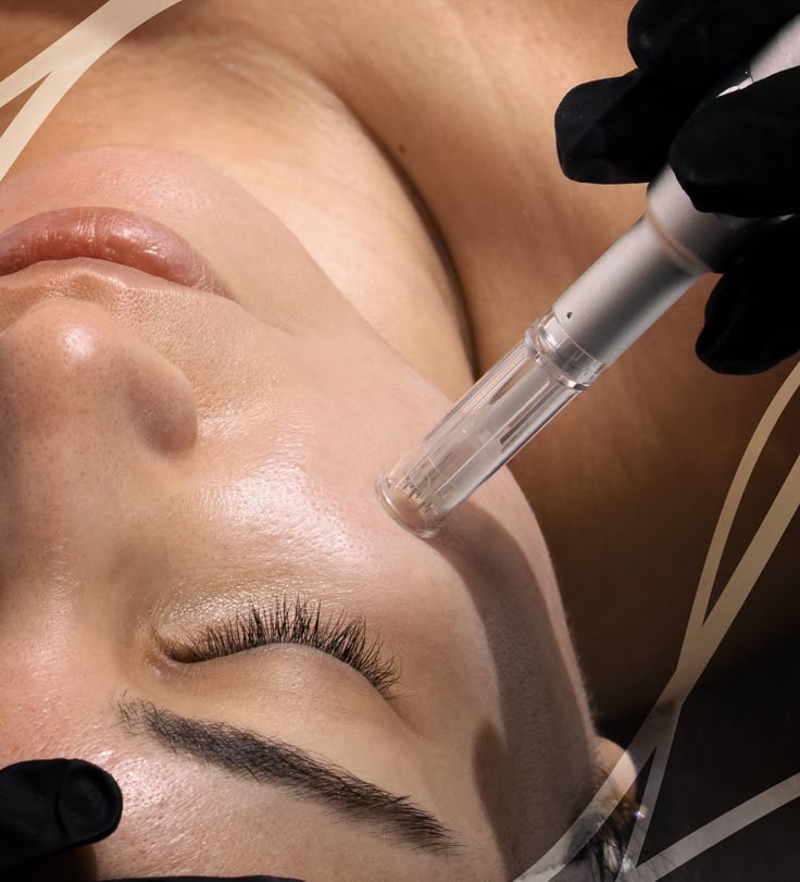 Le secret pour combattre le vieillissement cutané : le microneedling